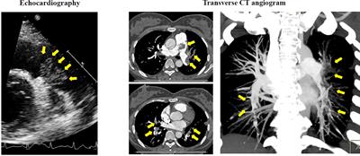 Rare pulmonary embolism in a pregnant patient: A primary diffused pulmonary artery myxofibrosarcoma case report